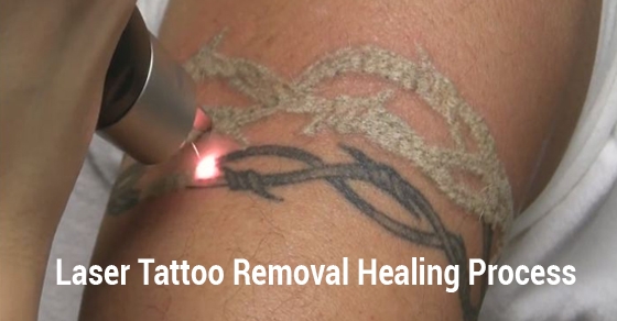 Laser Tattoo Removal Procedure Steps  YouTube