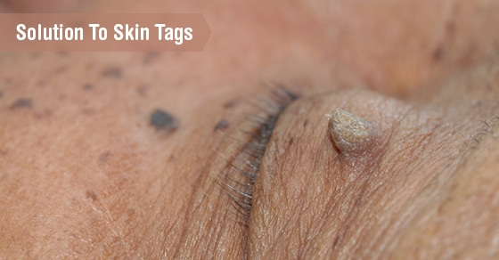 skin tag removal treatment toronto