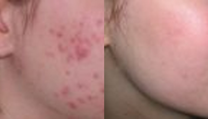 Acne &  Acne Scar Treatment