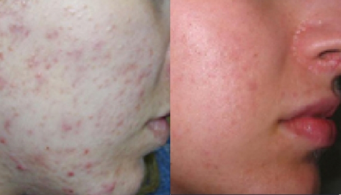 Acne &  Acne Scar Treatment