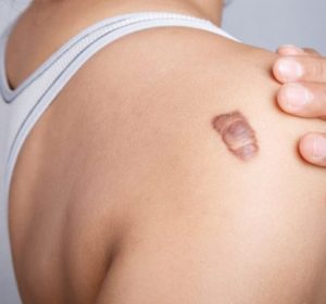 laser treatments for Keloid in toronto